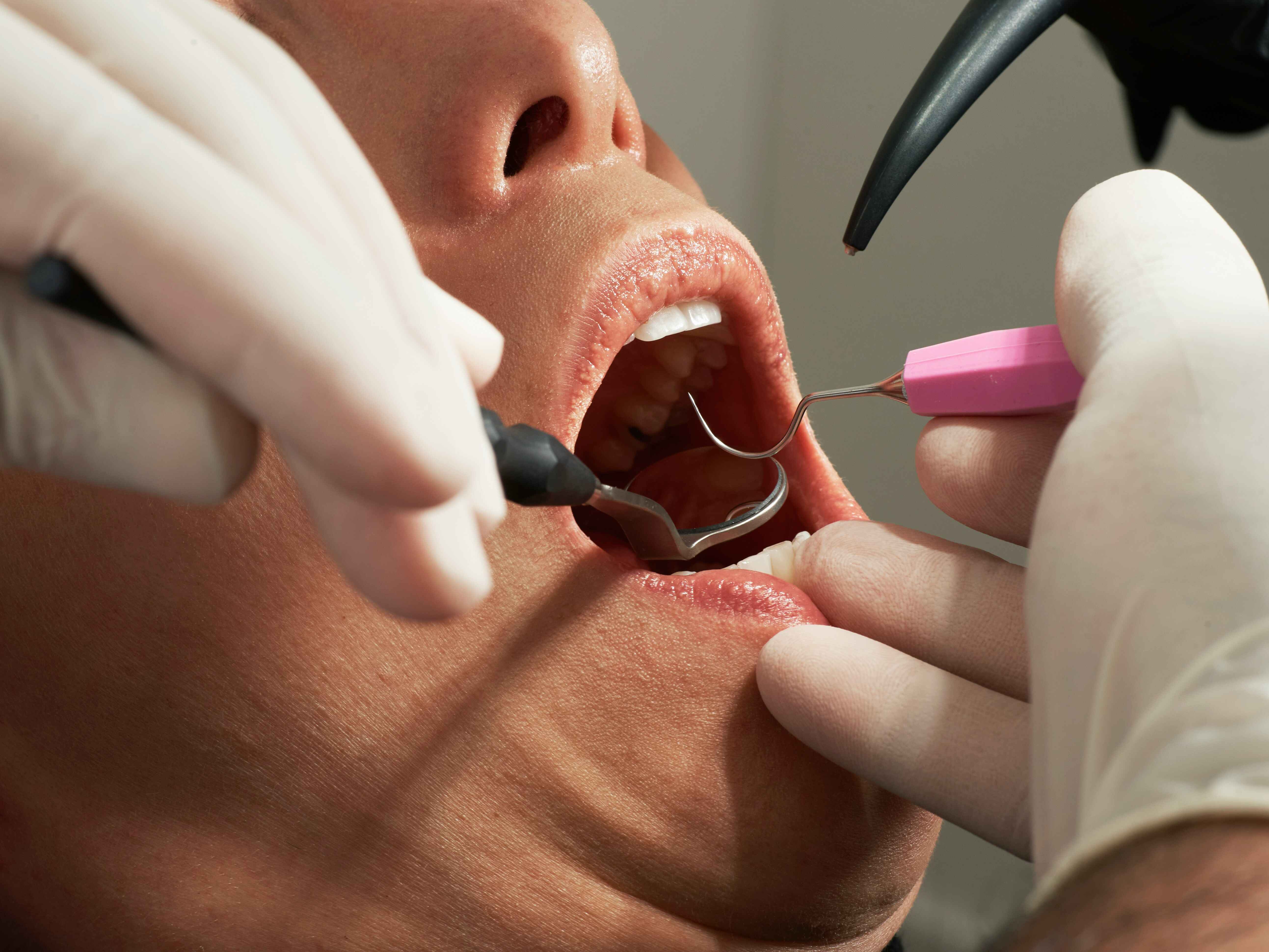 Girl getting dental work done